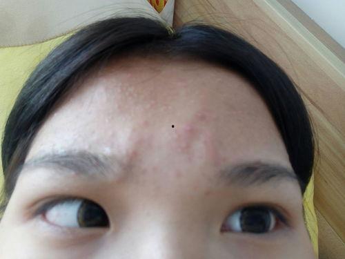 额头长痤疮图片,额头痤疮成因及护理攻略